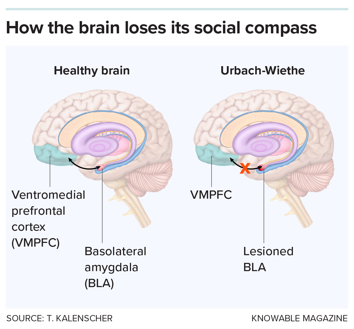 A graphic compares functioning in social decision-making in a brain of someone with Urbach-Wiethe disease and a normal brain.