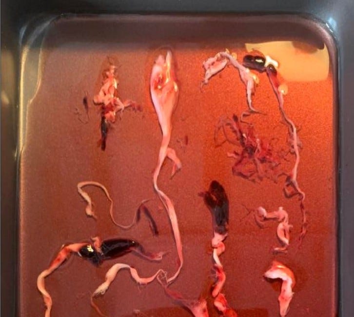 New study on the embalmer's clots