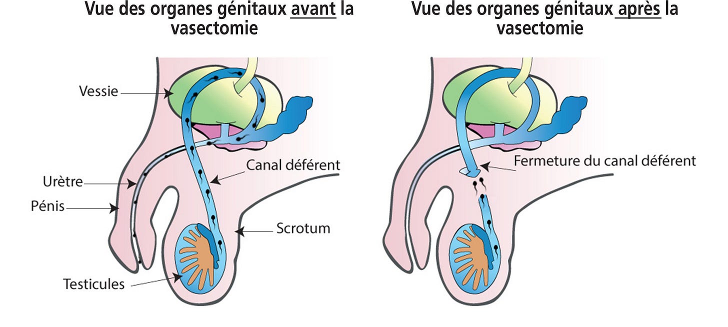 Qu&#39;est-ce que la vasectomie? - Vasectomie Québec