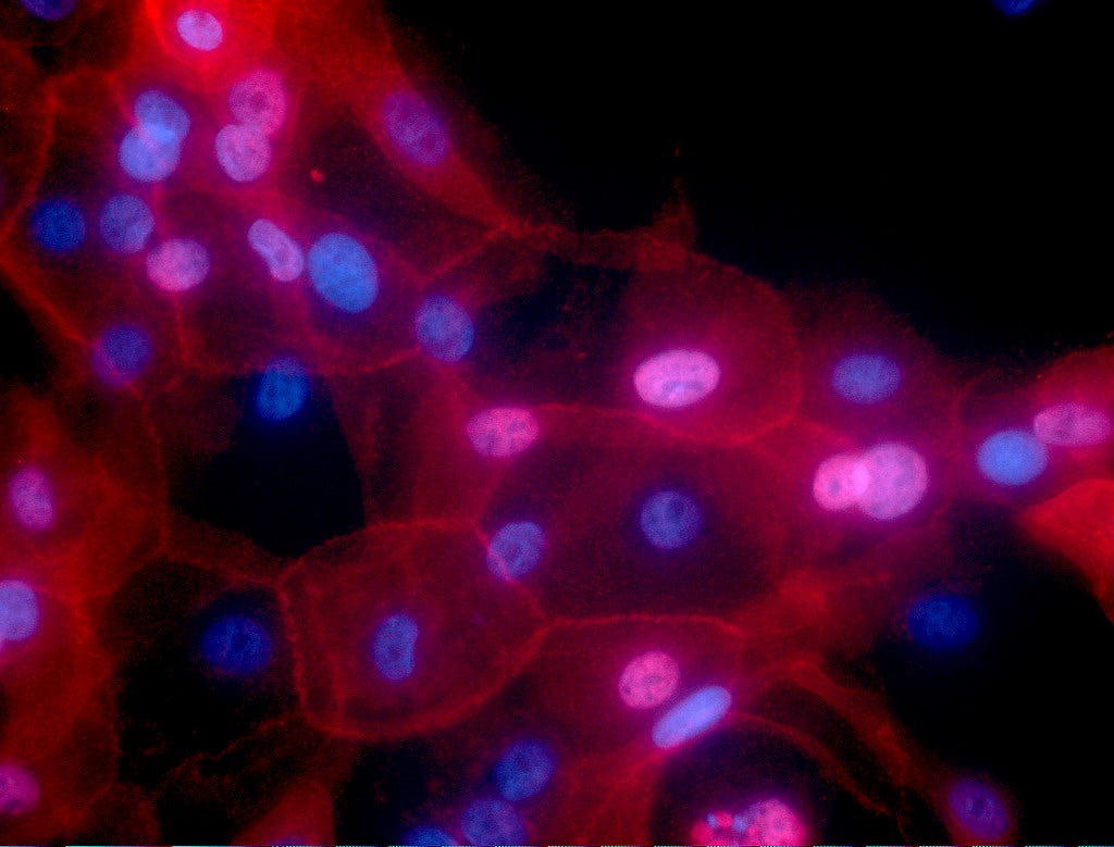 Breast Cancer Cells | The image shows cell culture of human … | Flickr