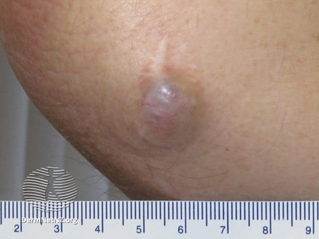 Skin Cancer Images - AIM at Skin Cancer Foundation Skin Cancer Images - AIM at Skin Cancer Foundation