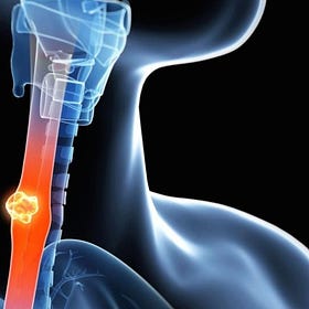 Case Report: Inoperable Metastatic Esophageal Adenocarcinoma, age 66, Male