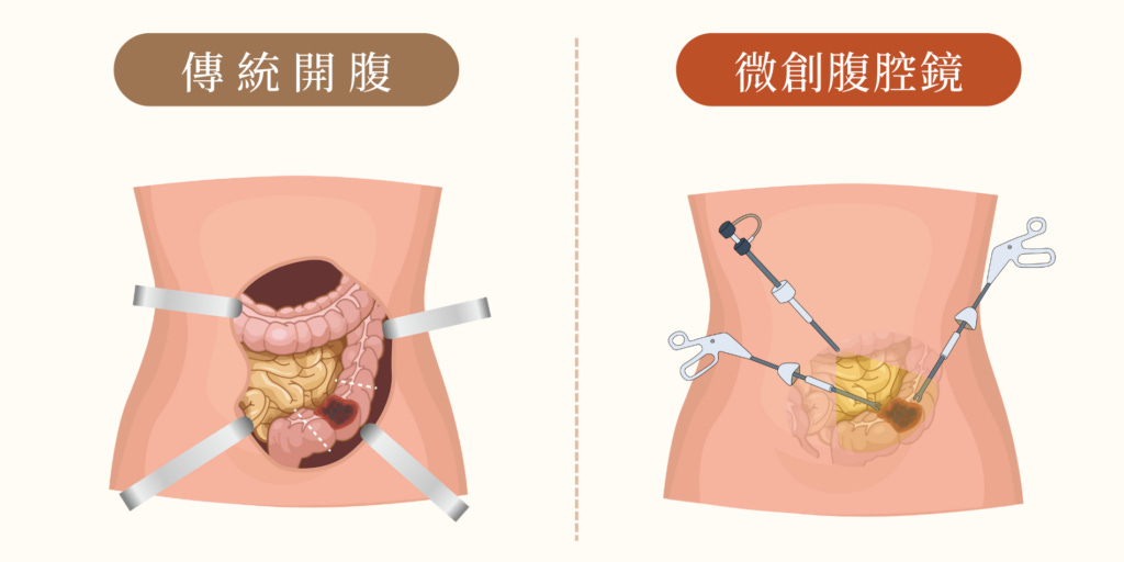 Source: 義大醫院大腸直腸外科