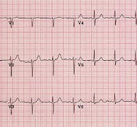 Normal_ECG (1)