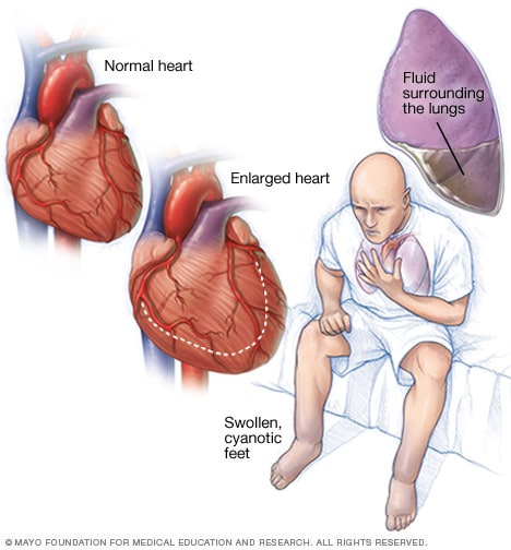 A person with heart failure A person with heart failure