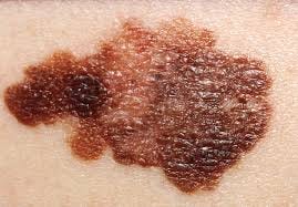 Melanoma - Wikipedia Melanoma - Wikipedia