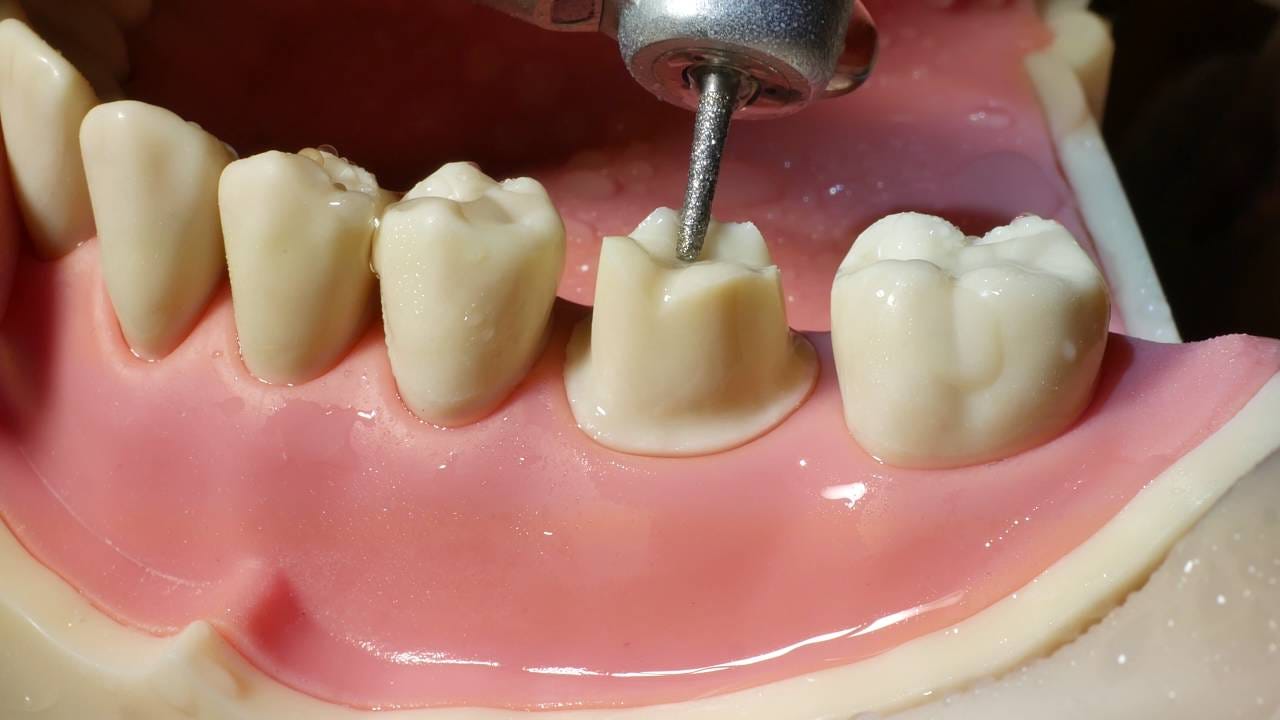 Molar Crown Preparation Walkthrough (tutorial) in the Simulation Lab -  YouTube