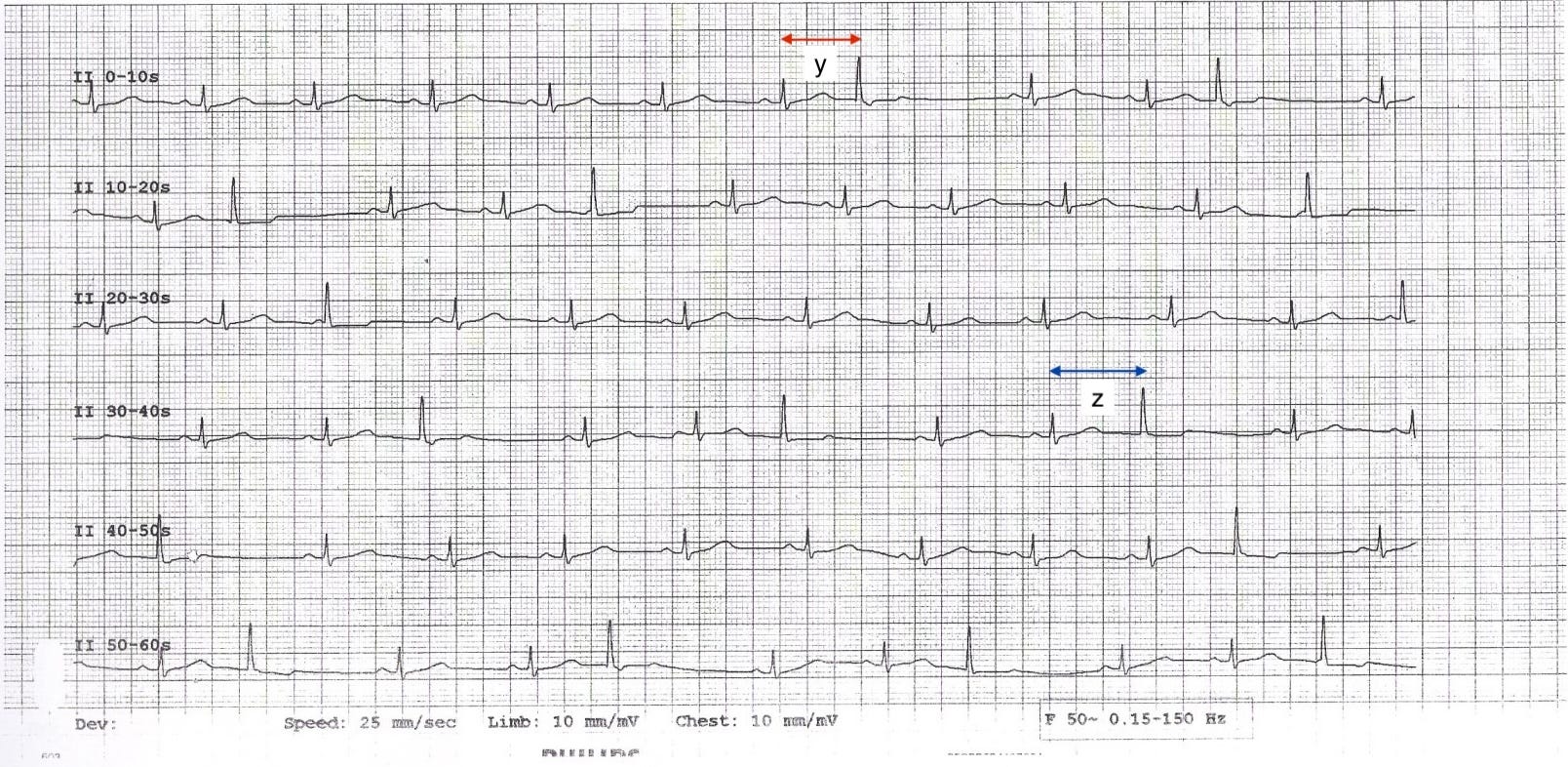Annotated 60-second lead II rhythm strip. Two coupling intervals (y and z) are marked between preceding sinus beats and ectopic beats, showing different lengths. Annotated 60-second lead II rhythm strip. Two coupling intervals (y and z) are marked between preceding sinus beats and ectopic beats, showing different lengths.