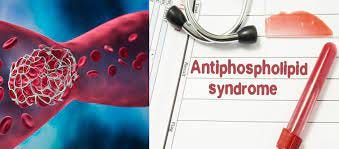 Detecting antibodies responsible for thromboses and miscarriages | Mirage  News