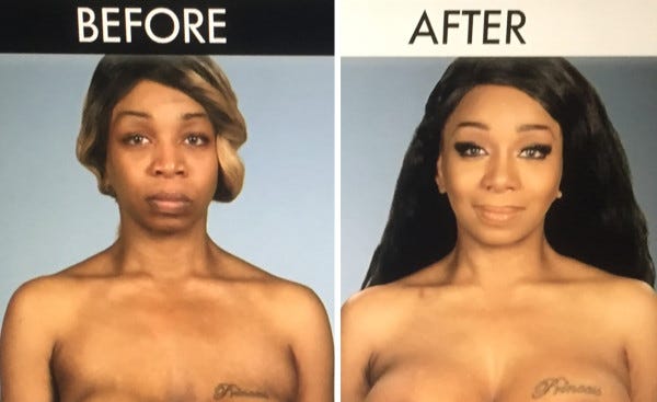 tiffany pollard before after botched boob job 2015 tiffany pollard before after botched boob job 2015