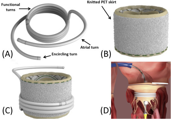 Transcatheter Mitral Valve Replacement: Technology Update - ScienceDirect