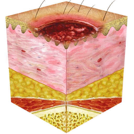 Ulcer Ulcer