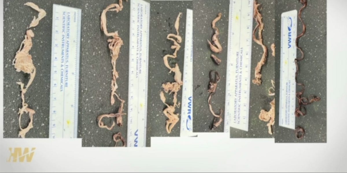 Do the Mysterious Fibrous Clots Really Exist?