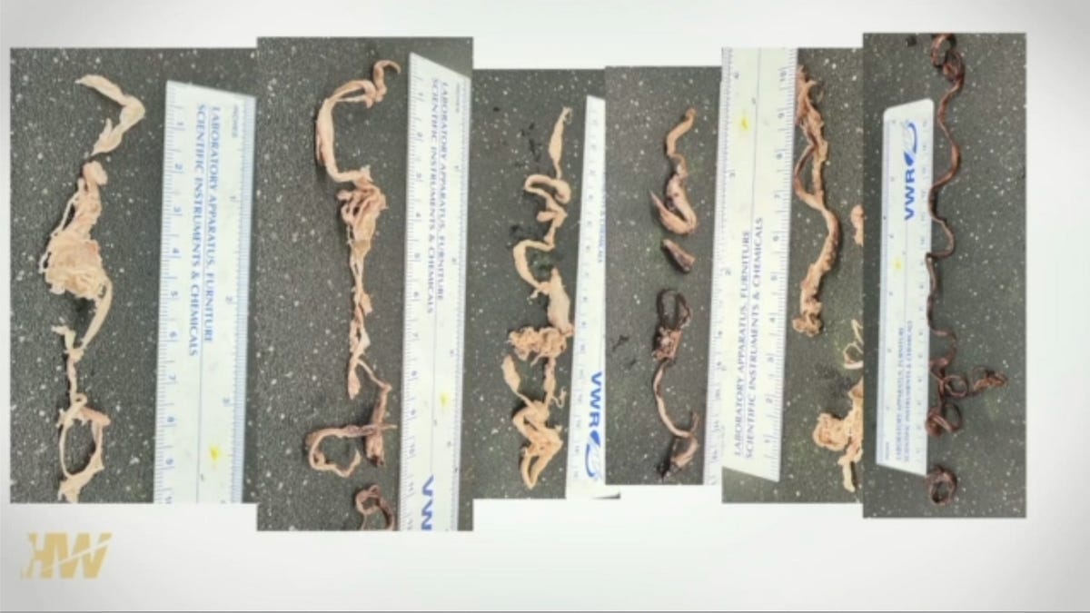 Do the Mysterious Fibrous Clots Really Exist?