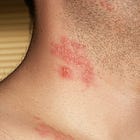 Herpes reactivation following COVID Vaccination