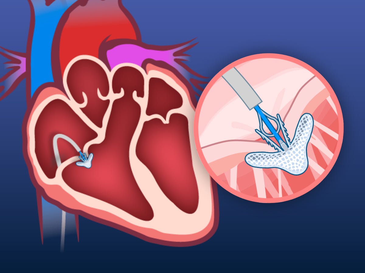 Transcatheter Repair for Tricuspid Regurgitation | New England Journal of Medicine Transcatheter Repair for Tricuspid Regurgitation | New England Journal of Medicine