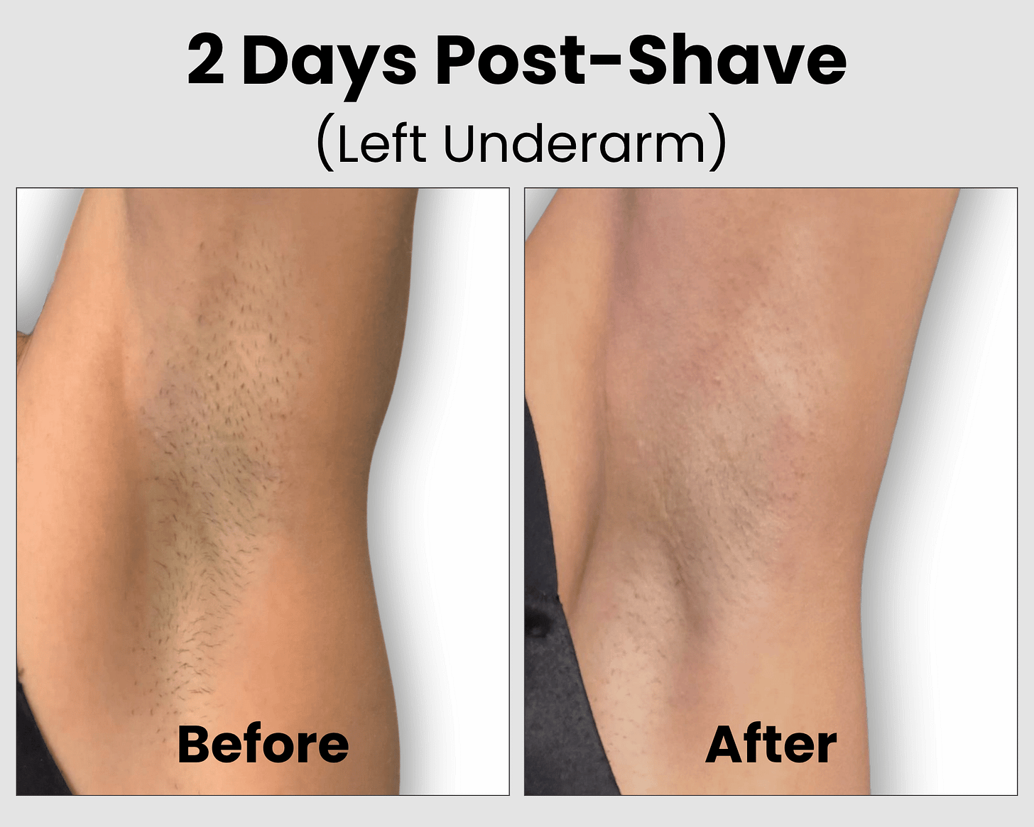 Ulike Air 10 Before and After Results on Fitzpatrick II and III Skin Left Underarm