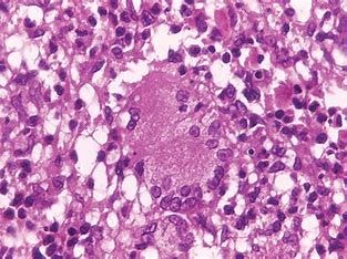 Mycobacterium Leprae