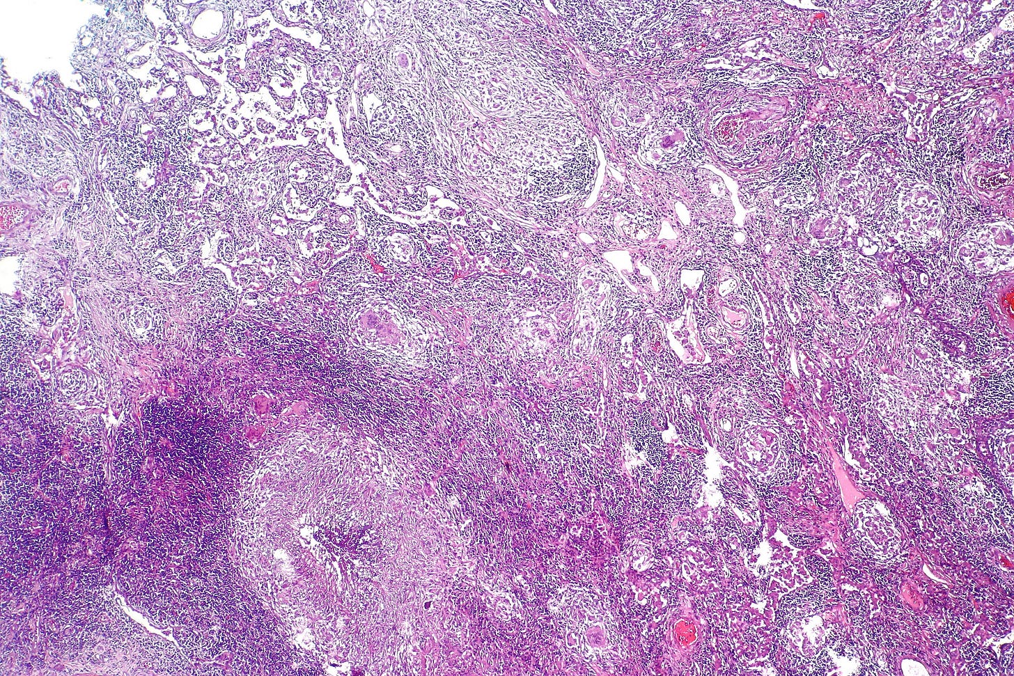 Microscopic view of tissue stained with hematoxylin and eosin, showing various cell structures and connective tissue in shades of pink and purple.