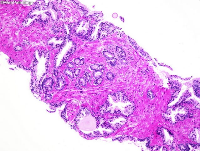 Microscope photo: Top and bottom glands have large meandering lumens; center has tightly packed small lumens. Microscope photo: Top and bottom glands have large meandering lumens; center has tightly packed small lumens.