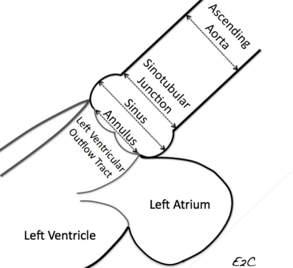 Is My Ascending Aorta Truly Enlarged or Enlarging?