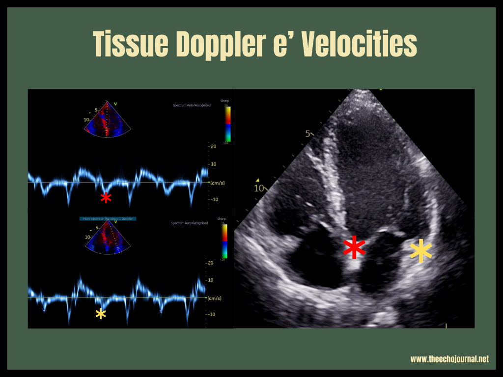 Unlocking Tissue Doppler Imaging: From Setup to Clinical Impact