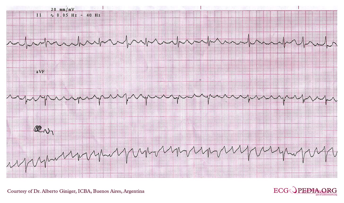 Coarse AF mimicking atrial flutter. Notice how the ventricular rhythm is IRREGULARLY irregular Coarse AF mimicking atrial flutter. Notice how the ventricular rhythm is IRREGULARLY irregular