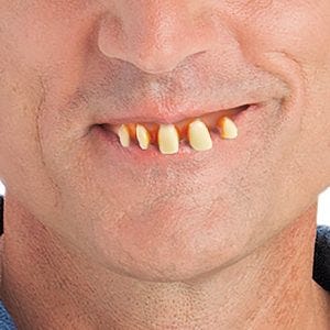 A man wearing fake bad teeth