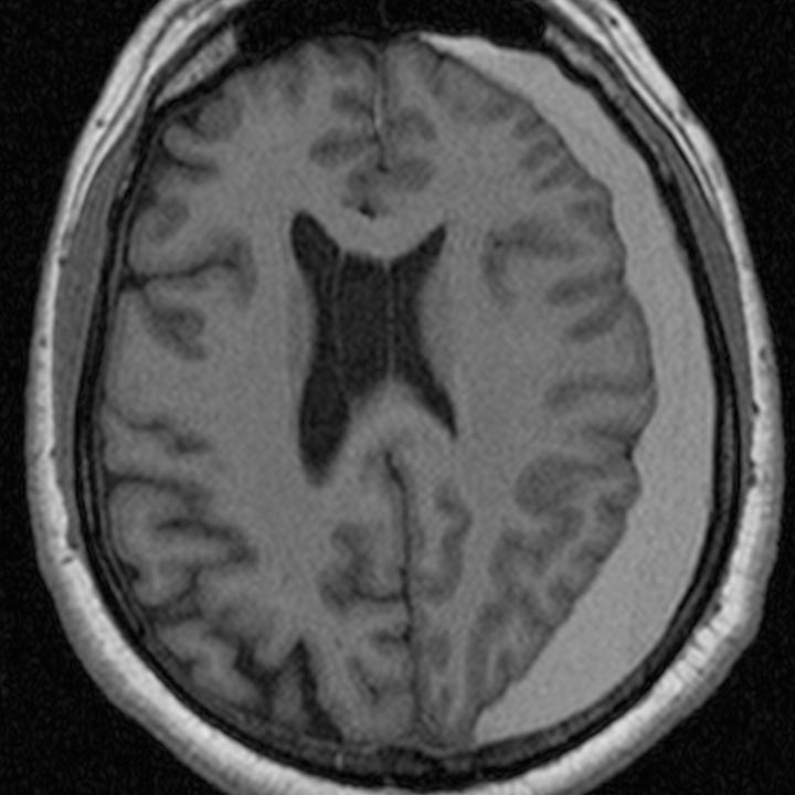 Subacute and chronic subdural hematoma