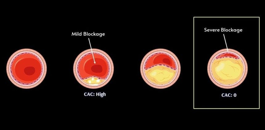 Non-calcified coronary plaque with calcium score of zero — soft plaques missed by CAC testing