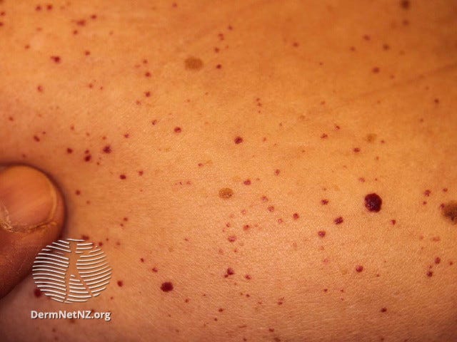 Angiokeratomas in suspected Fabry disease Angiokeratomas in suspected Fabry disease