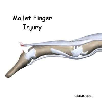 Mallet Finger Injury