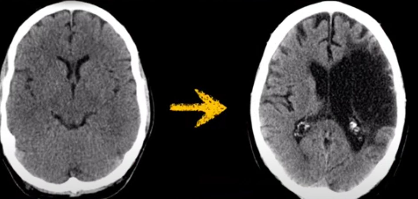 TC de AVC isquêmico, mostrando evolução temporal (Fonte: Radiopaedia)