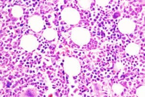Blood cancer cells