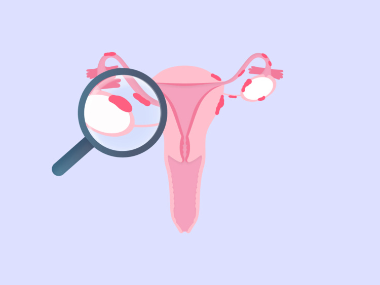 Everything you need to know about endometriosis Everything you need to know about endometriosis