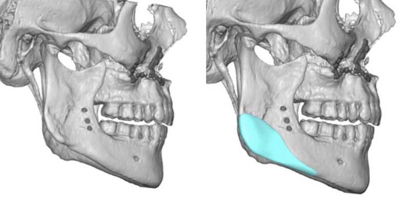 protese mandibular, preenchedor facial