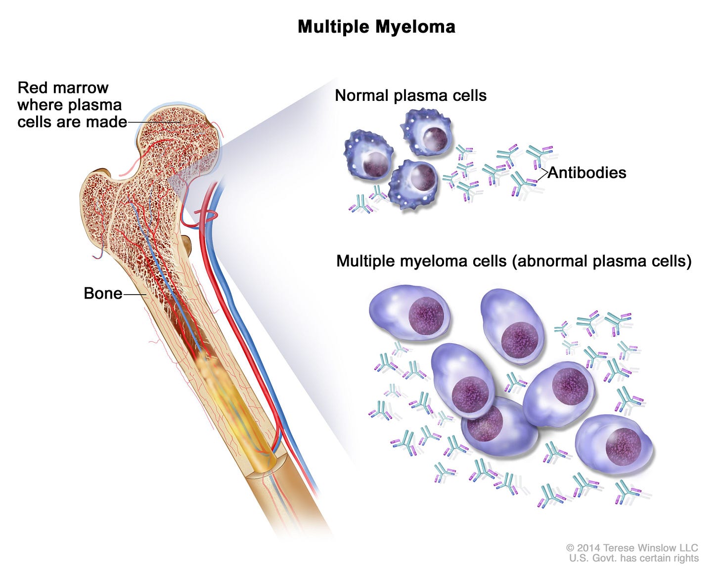 Definition of multiple myeloma - NCI Dictionary of Cancer Terms - NCI Definition of multiple myeloma - NCI Dictionary of Cancer Terms - NCI