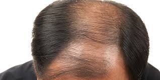 Male Pattern Baldness: Causes, Symptoms And Treatments