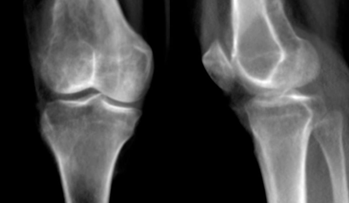 Case 12: Typical Distal Femur Lesion
