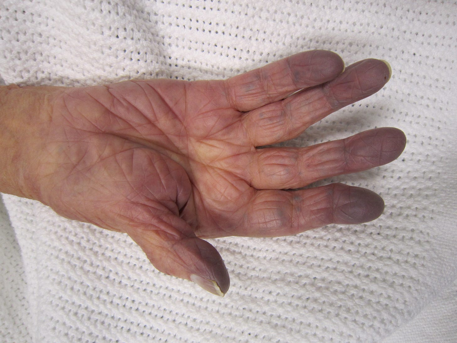 Cyanosis - Wikipedia