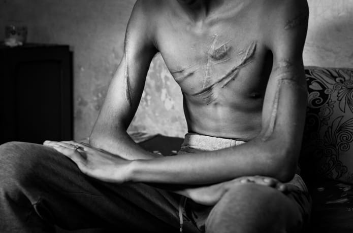 F.M. con un'ampia ferita sul petto in fase di cicatrizzazione