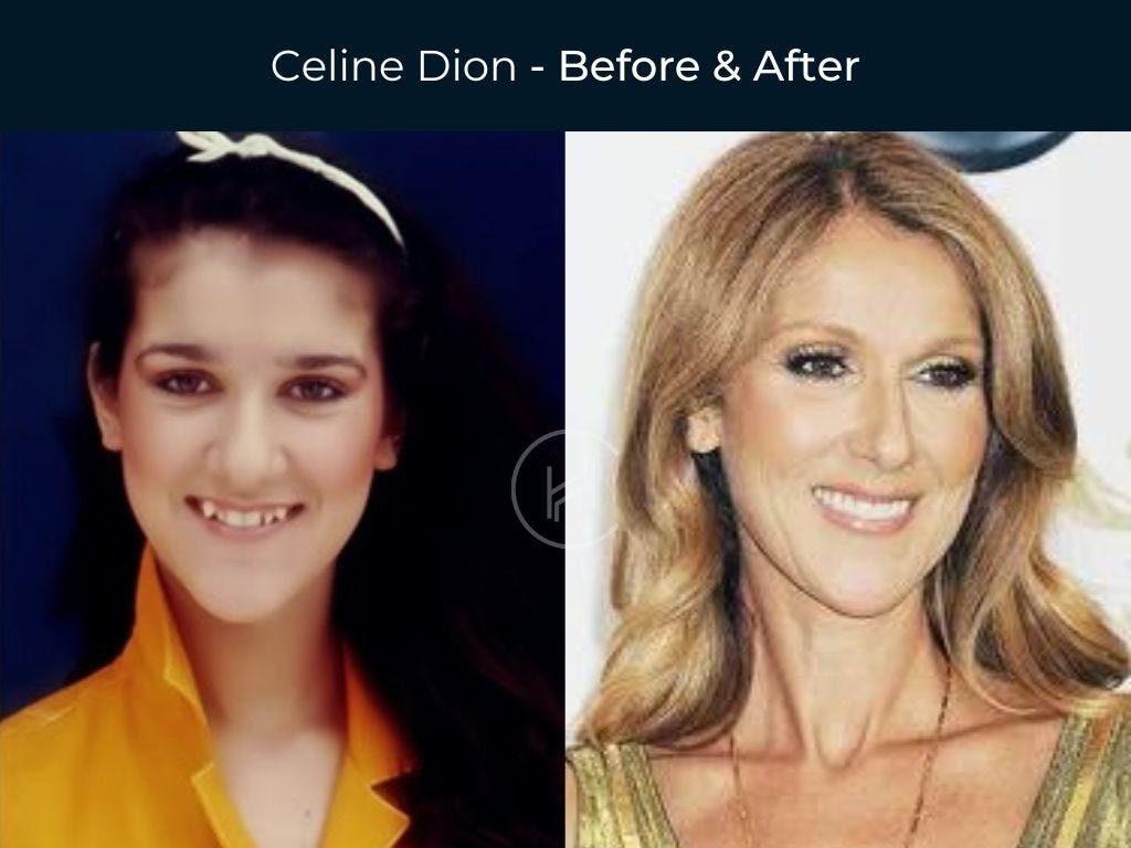 45 Celebrity Dental Implants and Veneers Before and After Photos