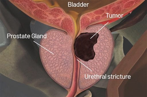 prostate cancer