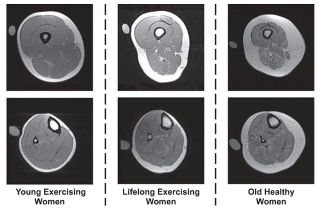 Muscle Mass Gets the Headlines, But Muscle Density Tells the Real Story