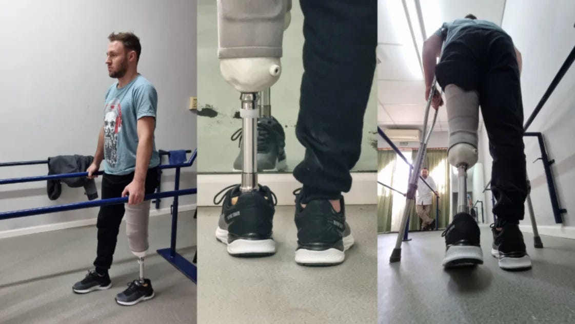 El joven accidentado en Charlone y la ruta 3 tuvo su primera sesión de rehabilitación con la prótesis