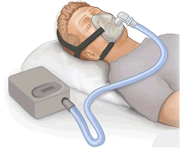 Fichier:CPAP.png