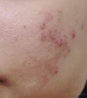 inflamed bleeding acne, pimples