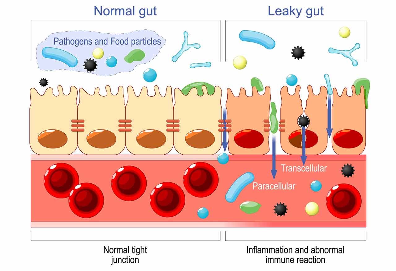 Leaky gut and Multiple Sclerosis Leaky gut and Multiple Sclerosis