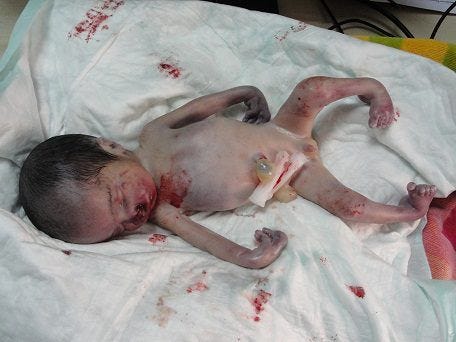 Fallujah | Boys, Baby boy, Club foot