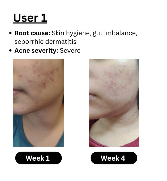 We targeted acne at its root, and helped 30+ people get healthier ...